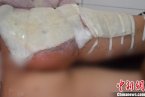 孩子咳嗽没钱治病 土方法草药熏蒸致严重烫伤
