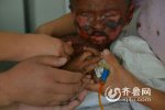 中毒性表皮坏死松解症男童命悬一线