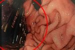 爱尔兰男子手机吞入食道 什么都吃?。? class=