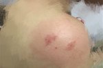 女子被虫叮咬后休克 隐翅虫咬人