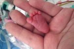 现实拇指姑娘降生 德国姑娘出生时体重4两